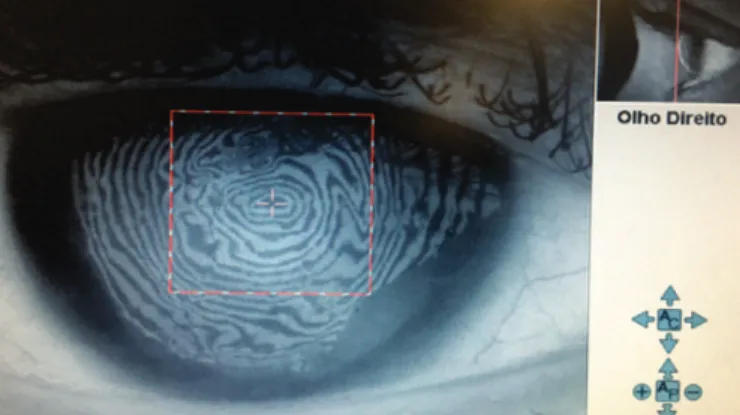 Figure 1. Specular biomicroscopy demonstrating a reduction in the  number of cells in the RE compared to the LE