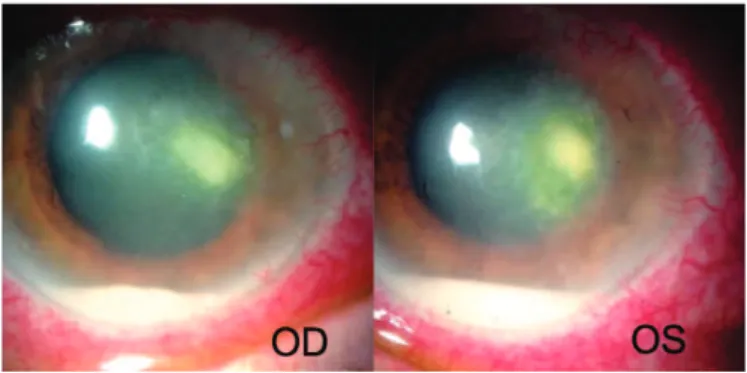 Figure 1. White infiltrate and hypopyon in both eyes