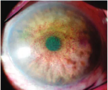 Figure 2: Floppiness of the upper eyelids one year later