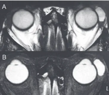 Figura 2. A e B. Ressonância nuclear magnética em T1 e T2, demons- demons-trando lesão cística e bem delimitada em glândula lacrimal esquerda.