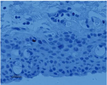 Figura 1. Análise imunohistoquímica e avaliação da proliferação  celular através da detecção do anticorpo Ki-67 da mostra do pterígio  sem uso de MMC pré-operatória