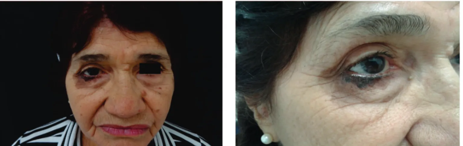Figure 3. Presence of blackened macula in the bulbar conjunctiva of  the right eye, not affecting palpebral conjunctiva