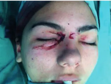 Figure 3. Removed the foreign body, bicanalicular intubation with  Sylastic, reintegration of medial canthal tendon right and suturing the  eyelids