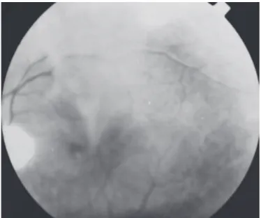 Figure 2 - Fundography OS: Maculoschisis and peripheral vitreous  membranes