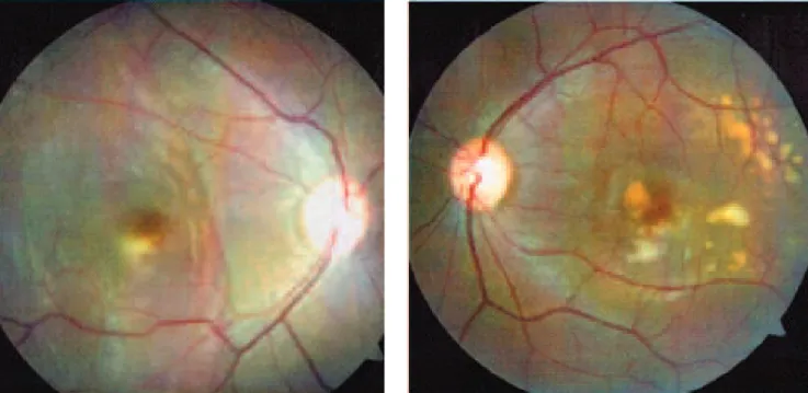 Figura 1. Retinografias: olho direito apresenta descolamento de retina regmatogênico extenso e uma lesão amarelada arredondada subfoveal