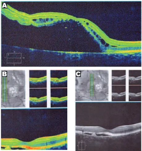 Figura 4. Tomografia de coerência óptica (OCT): (A) Descolamento de retina em olho direito associado a cistos intra-retinianos