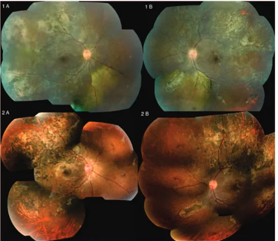 Figure 1 A and B. Retinography of the right and left eye respectively showing mild hyperemic optic disc, serous retinal detachment in the  periphery, hyper and hypopigmentation areas of RPE and vascular attenuation