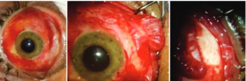 Figure 3: Peroperative findings: complete longitudinal rupture of left inferior rectus muscle with no detection of proximal portion