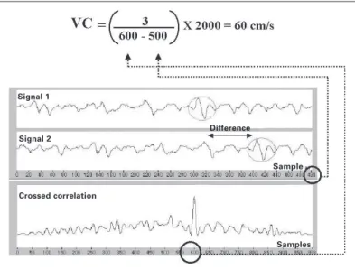 Fig. 3 – The difference presented by signals 1 and 2 collected by the pairs of electrodes and of sizes equal to 500 samples (L) is of approximately 100 samples