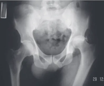 Figure 1 – Antero-posterior hip X-ray showing fracture-dislocation of the left hip