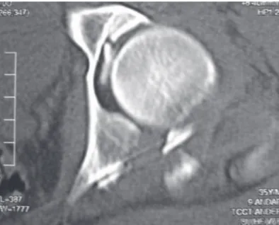 Figure 3 – Antero-posterior hip X-ray after synthesis of the acetabular pos- pos-terior bone fragment
