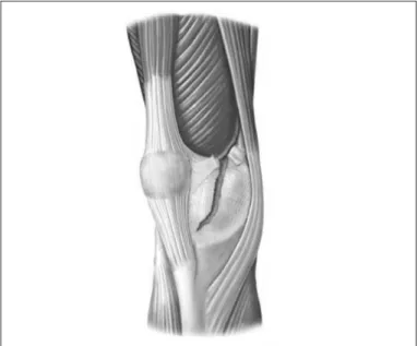 Figure 1: Drawing representing the rupture of the patellar medial stabilizers.