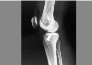 Figure 5. Example of both ACL positions, marked from transtibial and transortal te- te-chniques.