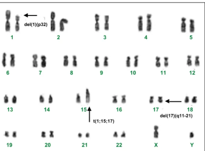 Fig. 2 – G-banded karyotype obtained from the acute promyelocytic leukaemia patient at diagnosis:  46,XY,t(1;15;17)(p32;q22;q11-21)