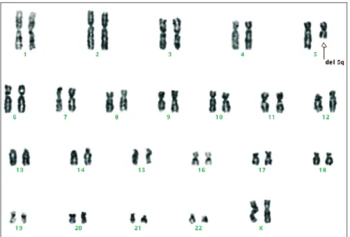 Fig. 2 – G-banded karyotype obtained from the myelodysplastic syndrome patient at diagnosis: