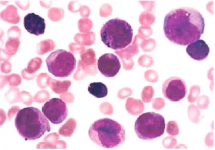 Fig. 1 – Bone marrow smear obtained from an acute myeloid leukaemia subtype M4Eo case at diagnosis showing blast cells and eosinophils with basophilic granules (Romanovsky, 1000x)