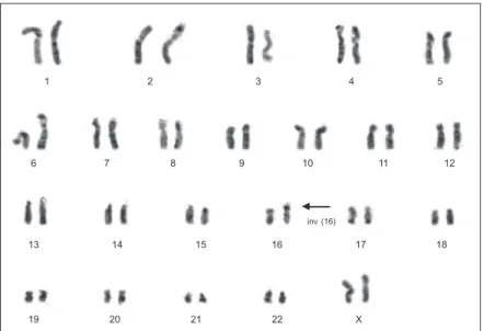 Fig. 2 – G-banded karyotype obtained from an acute myeloid leukaemia subtype M4Eo female case at diagnosis: 46,XX,inv (16)(p13;q22) The arrow shows the chromosomal abnormality