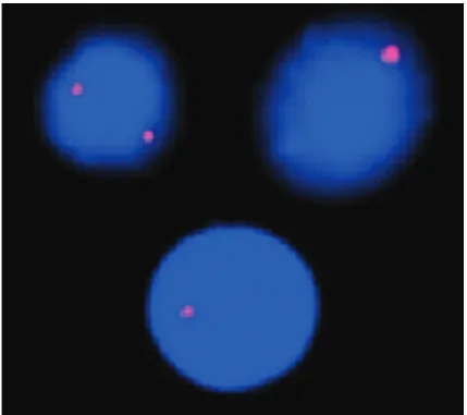 Fig. 3 – Interphase fluorescence in situ hybridisation analysis on the multiple myeloma patient’s plasma cells, using specific probe for D13S319 locus of the 13q14 region (Vysis, Downers Grove, IL, USA) (•).