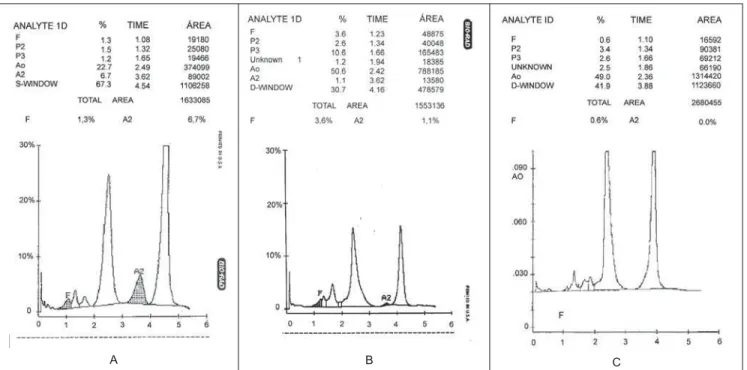 Figura 2: Amostras com Hb AS (A), Hb AD (B) e Hb A Korle-Bu (C) analisadas no sistema Variant de HPLC