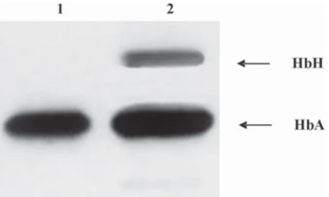Figura 4. Ethidium bromide-stained 2% agarose gel showing polymerase chain reaction products of haemoglobin H disease patient