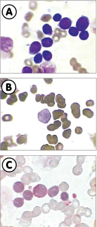 Figure 1. Bone marrow films showing blast cells (A) stained by peroxidase (B) and periodic acid-Schiff (C)