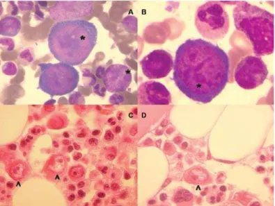 Figura 1. A e B. Citologia de medula óssea mostrando pró-eritroblastos gigantes com inclusões intranucleares sugerindo infecção viral (*)