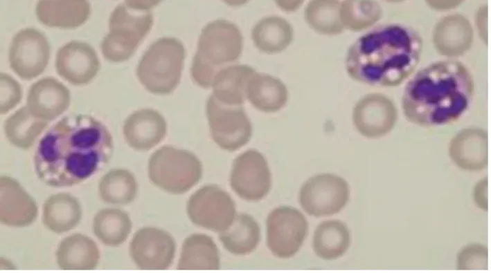 Figure 2. Prominent cytoplasmic vacuoles in neutrophils. Peripheral blood, stained with Leishman's stain: magnified 1000 x