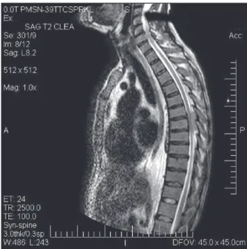 Figure 1 – T2-weighted sagittal magnetic resonance image showing a hyperintense extradural lesion at the eighth thoracic spinal segment