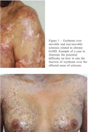 Figure 3 – Illustration of poikiloderma which may be difficult to score in the absence of sclerosis