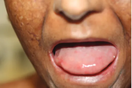 Figure 4 – Lip atrophy and restriction of mouth opening from sclerosis