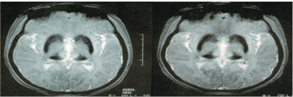 Figure 2 – Comparative study of brain MRI before (left) and six months after starting treatment with deferasirox (right) shows no change in the signal of basal ganglia structures