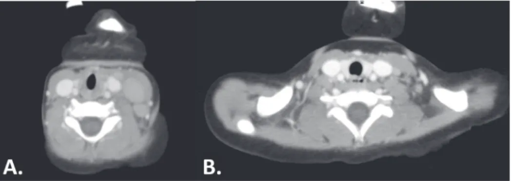 Figure 1 – Computed tomography of the cervical region. A. Initial scan showing lower left carotid-jugular cervical lymphadenomegaly (Grade IV) of up to 25mm (largest diameter); B