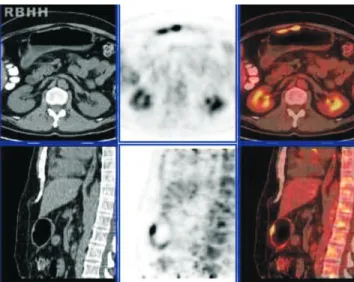 Figure 1 – High grade Hodgkin's lymphoma on PET/CT. First row shows the CT, second row shows the PET images and the third row shows the fused PET/CT images