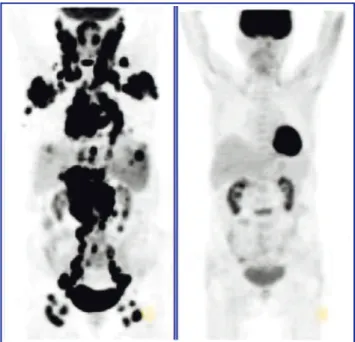 Figure 7 – Therapy monitoring with PET/CT. An example of complete response. Note that the multiple foci of  2-[fluorine-18]fluoro-2-deoxy-d-glucose uptake in abdominal lymph nodes seen on pre-therapy scan (left) show no more activity in the post-therapy st