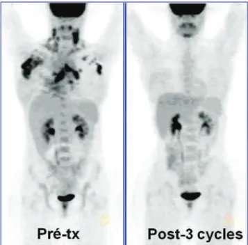 Figure 9 – An example of interim PET performed after 3 cycles of chemotherapy. Note a complete metabolic response after the first cycles of treatment indicating a low probability of relapse after completion of therapy