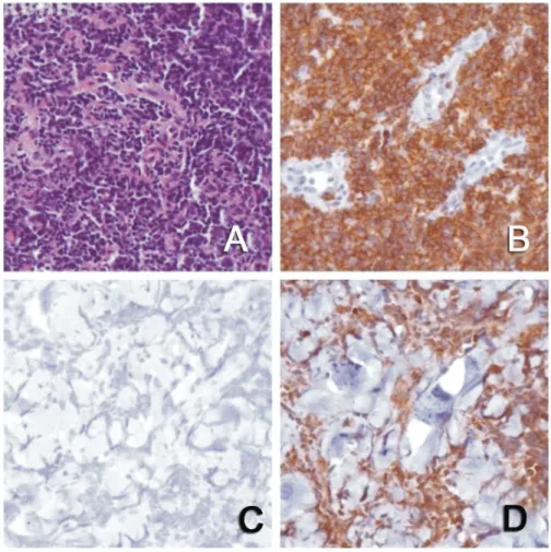Figure 1 C and D – CD20 -  diffuse large B cell lymphoma on relapse (C) and CD79a positive (D)