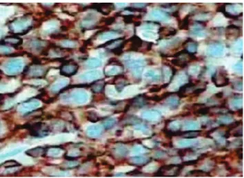Figure 2 – Immunohistochemical study showing atypical histiocytic proliferation, diffuse proliferation of large cells with irregular nuclei, conspicuous nucleoli and abundant cytoplasm