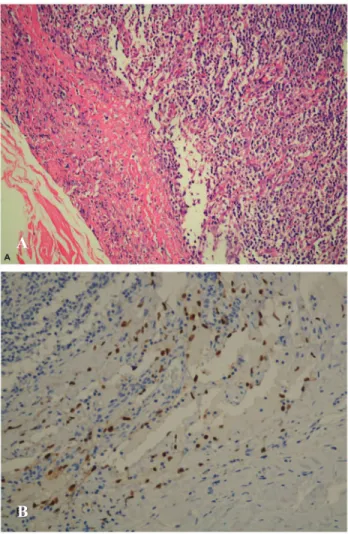 Figure 2 – Areas with nodal Kaposi's sarcoma.