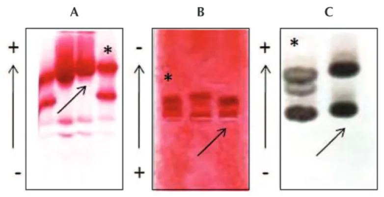 Figure 1 - Electrophoretic proile obtained by alkaline pH (A), acid pH (B)  and globin chain in alkaline pH (C); 