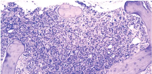 Figure 1 - Bone marrow replaced with metastatic breast ductal carcinoma, H&amp;E stain, original magnification 200X