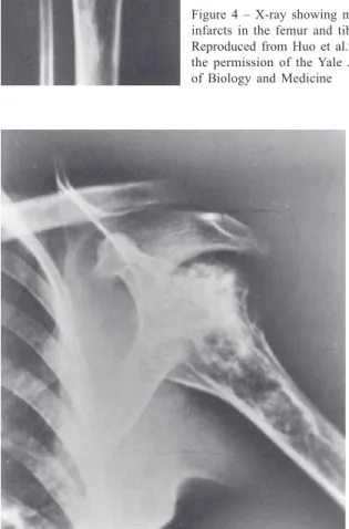 Figure 4 – X-ray showing multiple infarcts in the femur and tibia.