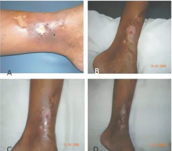 Figure 1 – Outline of the leg ulcer on clear plastic before treatment (left) and after laser therapy (right)
