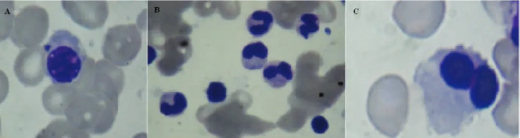 Figure 1 – Dysplastic changes of the erythroid, granulocytic and megakaryocytic lineages in bone marrow  aspirate