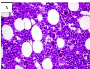 Figure 1 – Bone marrow histology. Moderate hypercellularity and mild maturation arrest of the granulocytic compartment, predominating in the