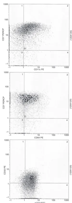 Figure 3 – G-banding chromosome analysis showing isolated del(17)(p11.2). Thus, based on the 2008 revision of the WHO classification of myeloid neoplasms and acute leukemia, 5 a diagnosis of MPAL, T-cell/myeloid with a monocytic component was made.