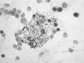 Figure 1 – Large cells (histiocytes) with their abundant cytoplasm filled with acid-fast bacilli (Mycobacterium leprae) in bone marrow (Ziehl-Neelsen stain) magnification 1000×.