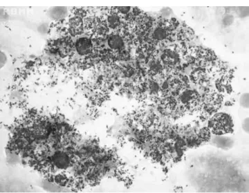 Figure 2 – Large cells (histiocytes) with their abundant cytoplasm filled with acid-fast bacilli (Mycobacterium leprae) in bone marrow (Fite-Faraco stain) magnification 1000×.