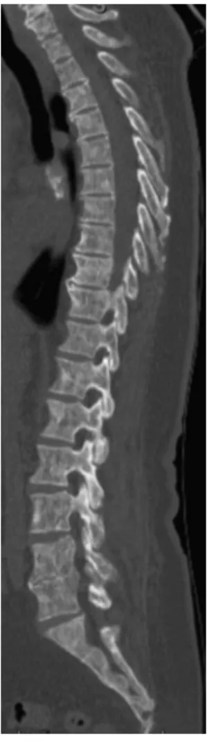 Figure 1 – Computed tomography scan of the lumbar spine and sacrum – scattered osteosclerotic lesions on vertebrae, sacrum and iliac bones (coronal view).
