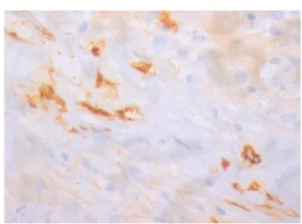 Figure 4 – Positive staining for CD117 (magnification: 400×) identifying atypical mast cells with fusiform shape.
