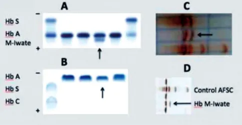 Figure 1 – High performance liquid chromatography chromatogram  (beta thalassemia short program) when the child was 45 days old